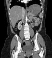 Bilateral ovarian mature cystic teratomas (Radiopaedia 79373-92457 B 44).jpg