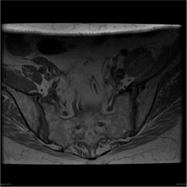 File:Bilateral psoas hematomas (Radiopaedia 24057-24280 T1 10).jpg