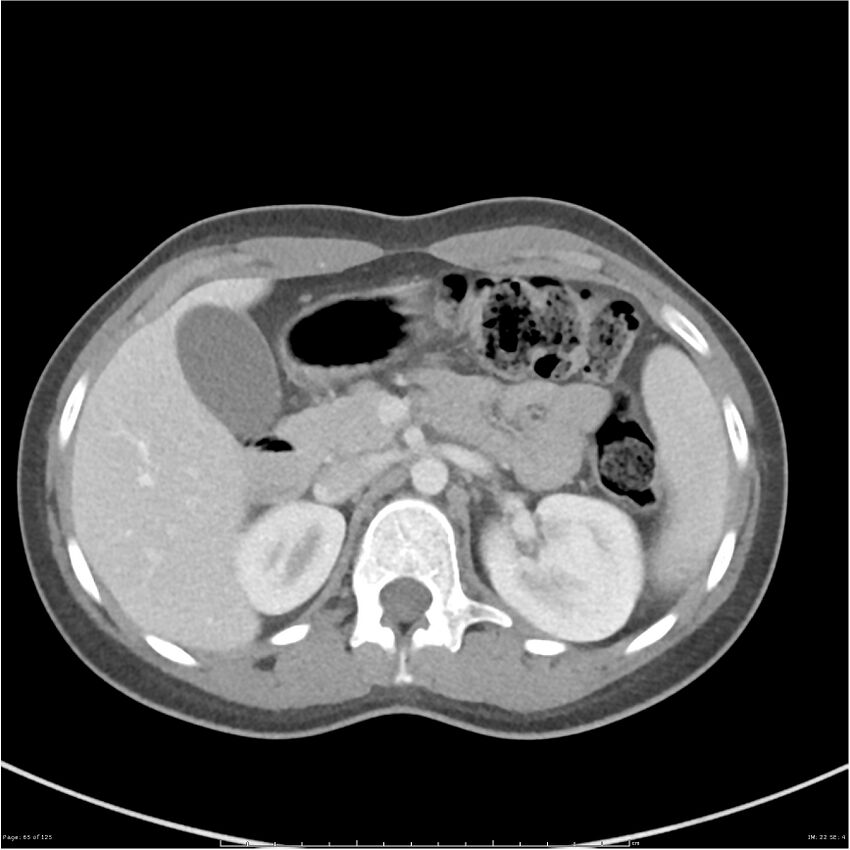 Bilateral ureteritis and cystitis (Radiopaedia 25340-25594 A 22).jpg