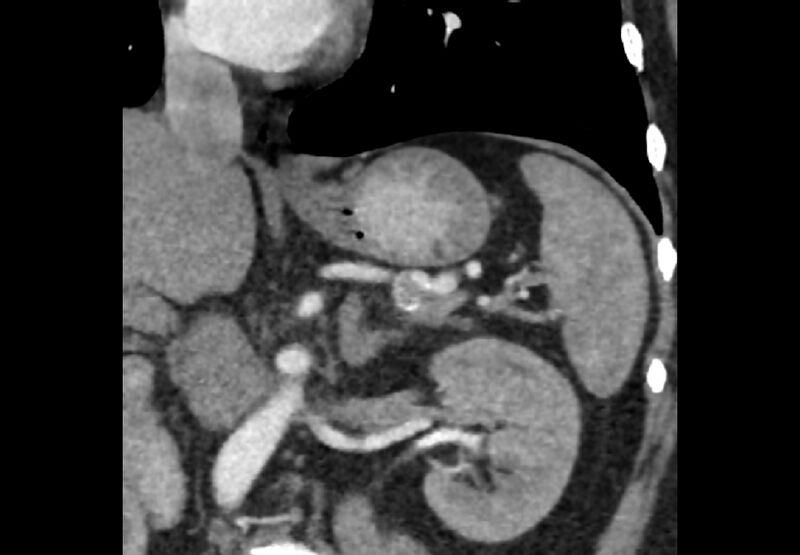 File:Bilateral urolithiasis with incidentally detected splenic artery aneurysm and left inferior vena cava (Radiopaedia 44467-48127 Ob. Cor. C+ Art. 17).jpg