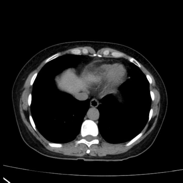 File:Bosniak renal cyst - type I (Radiopaedia 27479-27675 Axial non-contrast 7).jpg