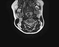 Brachial plexus birth palsy (Radiopaedia 68118-77604 Axial T2 5).jpg