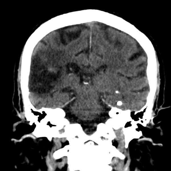 File:Brain Pantopaque remnants (Radiopaedia 78403-91048 Coronal non-contrast 42).jpg
