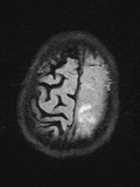 File:Brain abscess with dual rim sign (Radiopaedia 87566-103938 Axial FLAIR 21).jpg