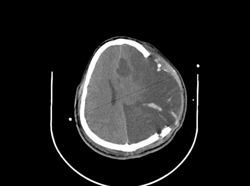 Brain injury by firearm projectile (Radiopaedia 82068-96087 B 129).jpg