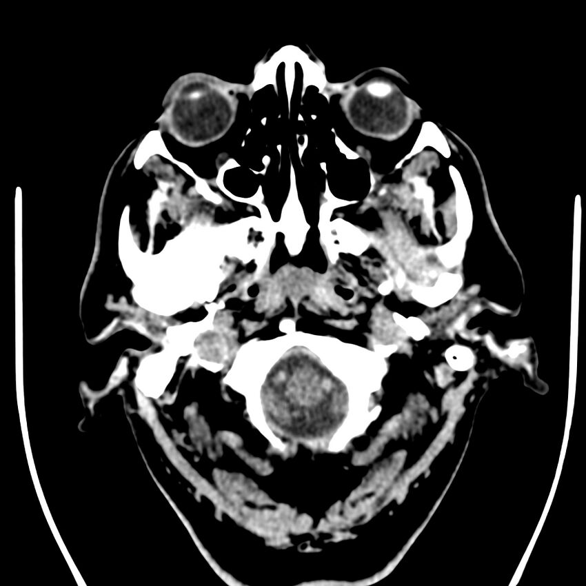 Brain metastasis (Radiopaedia 42617-45760 Axial non-contrast 1).jpg