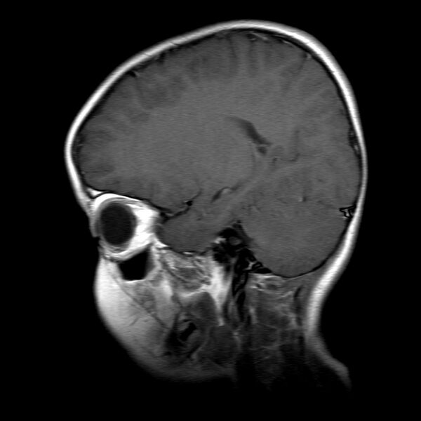 File:Brainstem ganglioglioma (Radiopaedia 10763-11224 Sagittal T1 C+ 13).jpg