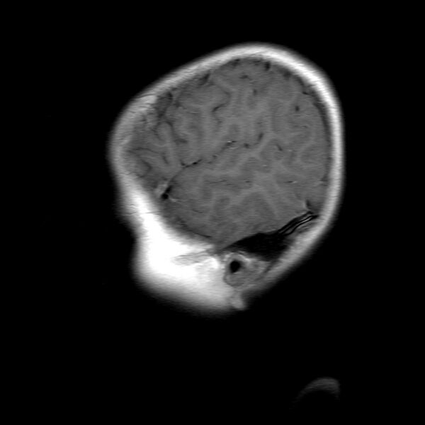 File:Brainstem ganglioglioma (Radiopaedia 10763-11224 Sagittal T1 C+ 17).jpg