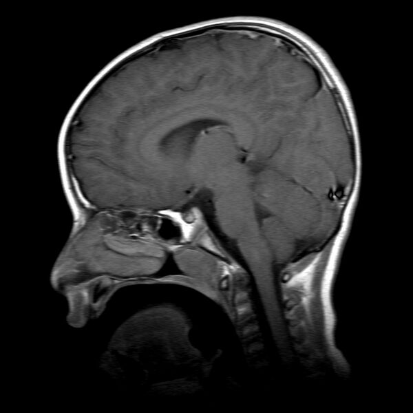 File:Brainstem ganglioglioma (Radiopaedia 10763-11224 Sagittal T1 C+ 9).jpg