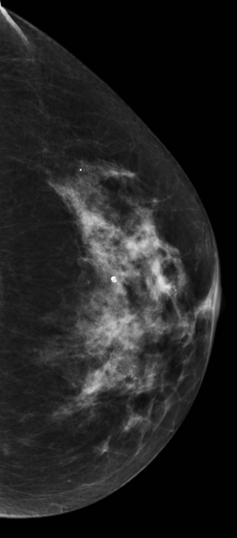 File:Breast asymmetry - interpretation pitfall (Radiopaedia 21654-21614 CC 1).png