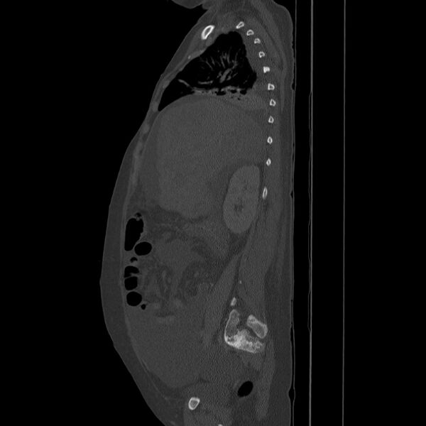 File:Breast cancer metastases - hepatic and skeletal (Radiopaedia 34201-35461 Sagittal bone window 35).jpg