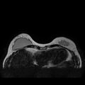 Breast implants - MRI (Radiopaedia 26864-27035 Axial T2 10).jpg