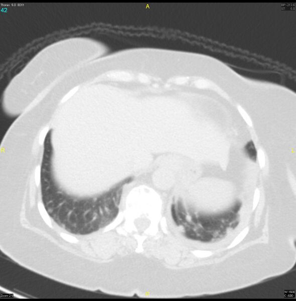 File:Breast primary with lung and bone metastases (Radiopaedia 40620-43228 Axial lung window 42).jpg
