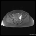 Broad ligament fibroid (Radiopaedia 49135-54241 Axial T1 fat sat 14).jpg