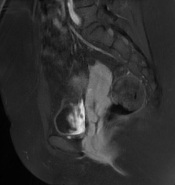 File:Broad ligament leiomyoma (Radiopaedia 81634-95516 G 17).jpg