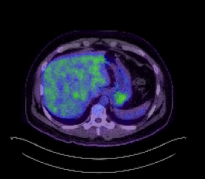 File:Bronchial carcinoid tumor (Radiopaedia 67377-76766 18FDG-PET-CT 37).jpg
