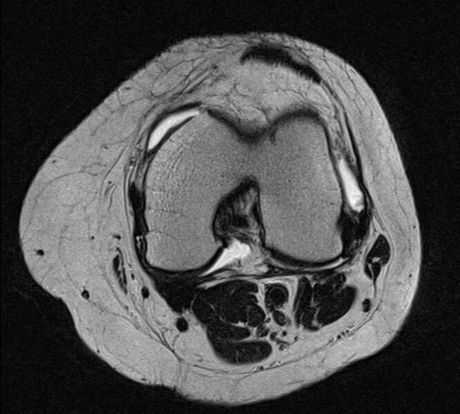 File:Bucket handle tear - medial meniscus (Radiopaedia 79028-91942 Axial T2 14).jpg