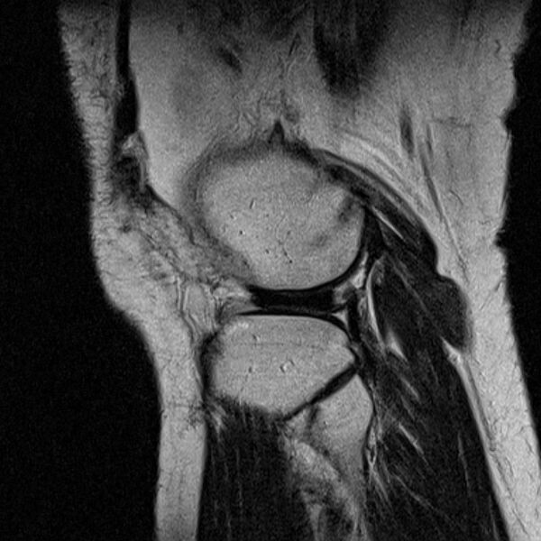 File:Bucket handle tear - medial meniscus (Radiopaedia 79028-91942 Sagittal T2 4).jpg