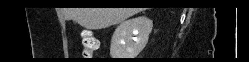 File:Buried bumper syndrome - gastrostomy tube (Radiopaedia 63843-72575 Sagittal Inject 96).jpg