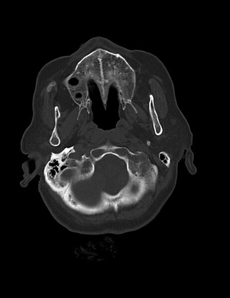 File:Burnt-out meningioma (Radiopaedia 51557-57337 Axial bone window 4).jpg