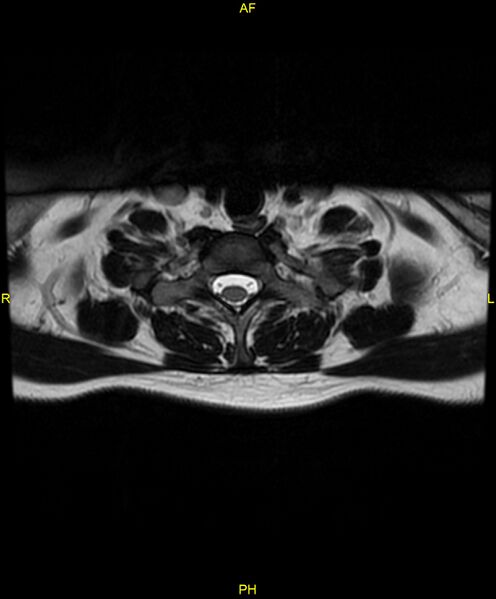 File:C5 nerve sheath tumor (Radiopaedia 85777-101596 Axial T2 71).jpg