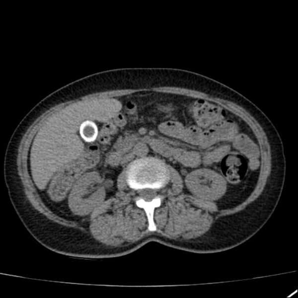 File:Calcified hepatic hydatid cyst (Radiopaedia 26872-27046 Axial non-contrast 40).jpg