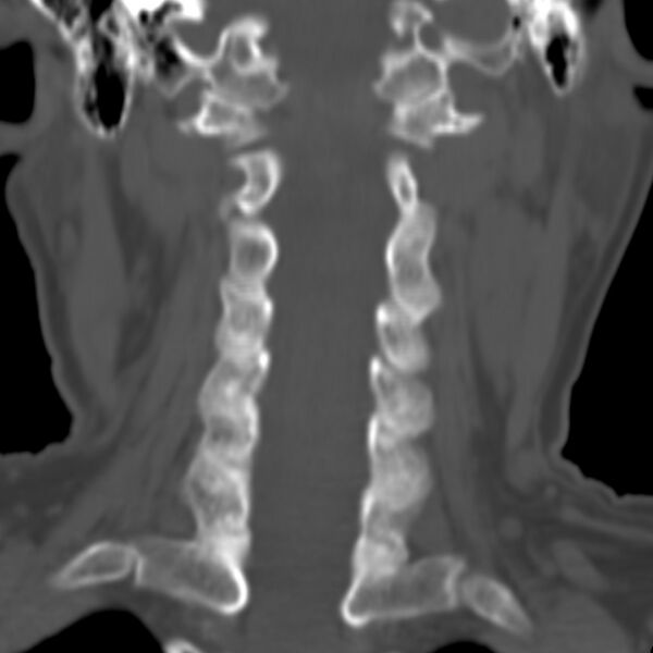 File:Calcified meningioma - cervical canal (Radiopaedia 70136-80171 Coronal bone window 12).jpg