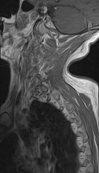 File:Calcified meningioma - cervical canal (Radiopaedia 70136-82468 Sagittal 2).jpg