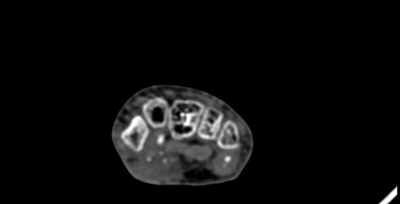 File:Calcifying aponeurotic fibroma (Radiopaedia 88423-105064 B 84).jpg