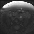 Cancer cervix - stage IIb (Radiopaedia 75411-86615 T1 fat sat 26).jpg