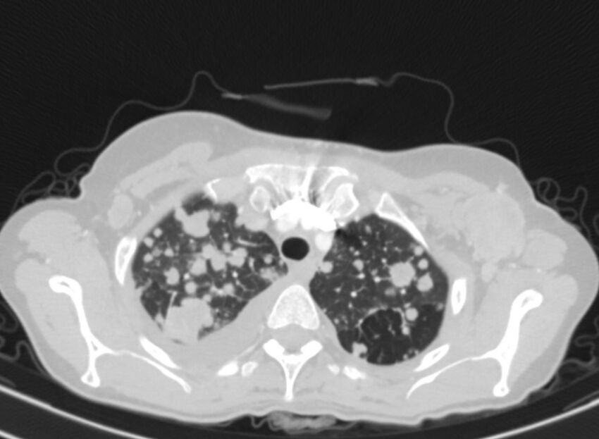 Cannonball metastases from breast cancer (Radiopaedia 91024-108569 Axial lung window 15).jpg