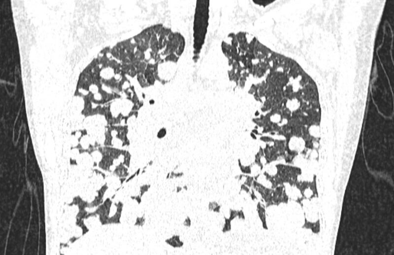 File:Cannonball metastases from breast cancer (Radiopaedia 91024-108569 Coronal lung window 76).jpg
