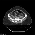 Carcinoma cervix- brachytherapy applicator (Radiopaedia 33135-34173 Axial non-contrast 7).jpg
