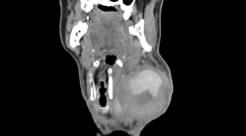 File:Carotid artery pseudoaneurysm - left (Radiopaedia 84030-99259 Coronal 25).jpg