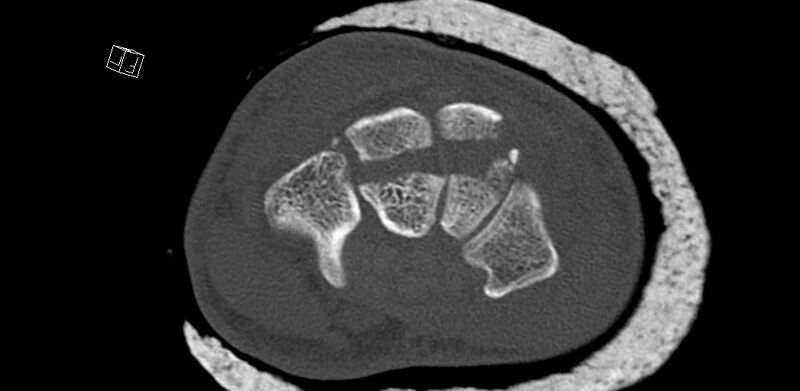 File:Carpal fractures (smart watch impaction) (Radiopaedia 55844-62430 Axial bone window 36).jpg