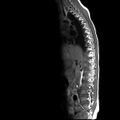 Caudal regression syndrome (Radiopaedia 61990-70072 Sagittal T1 2).jpg