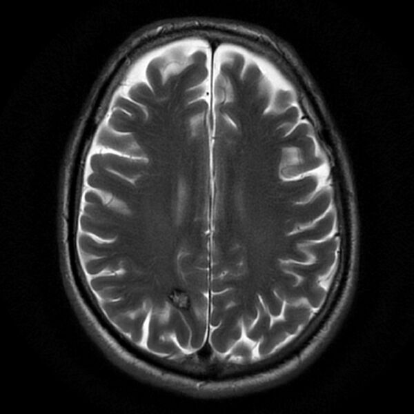 File:Cavernous hemangioma - brain (Radiopaedia 9773-10378 Axial T2 1).jpg