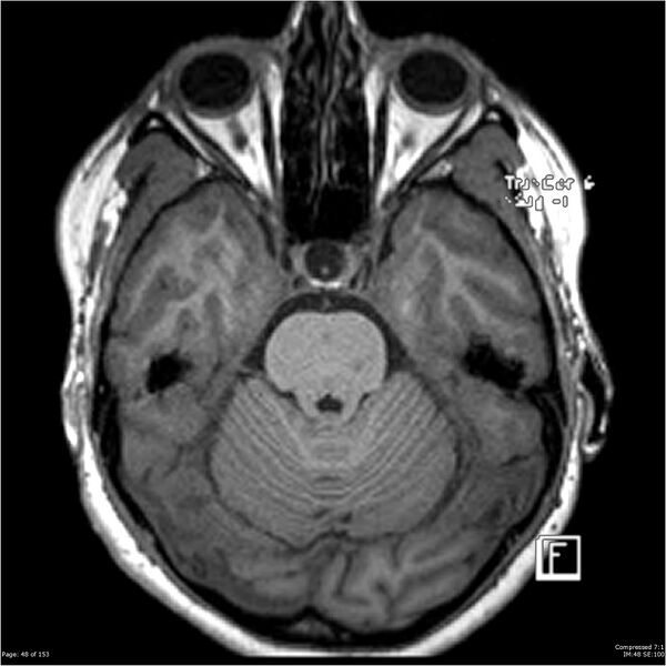 File:Cavernous malformation (cavernous angioma or cavernoma) (Radiopaedia 36675-38237 Axial T1 37).jpg