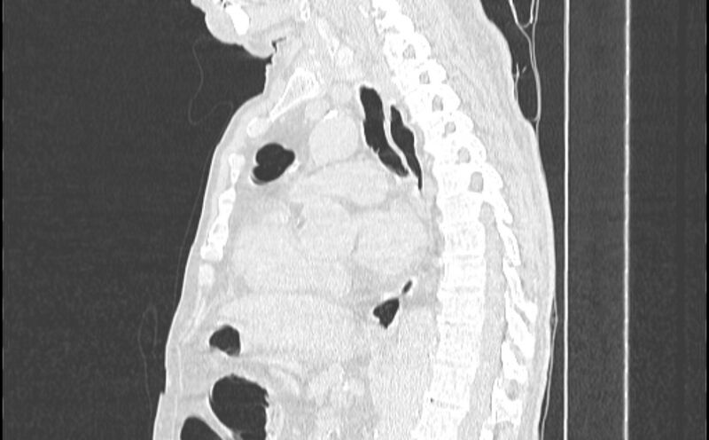 File:Cavitating bronchogenic carcinoma (Radiopaedia 44489-48162 Sagittal lung window 30).jpg