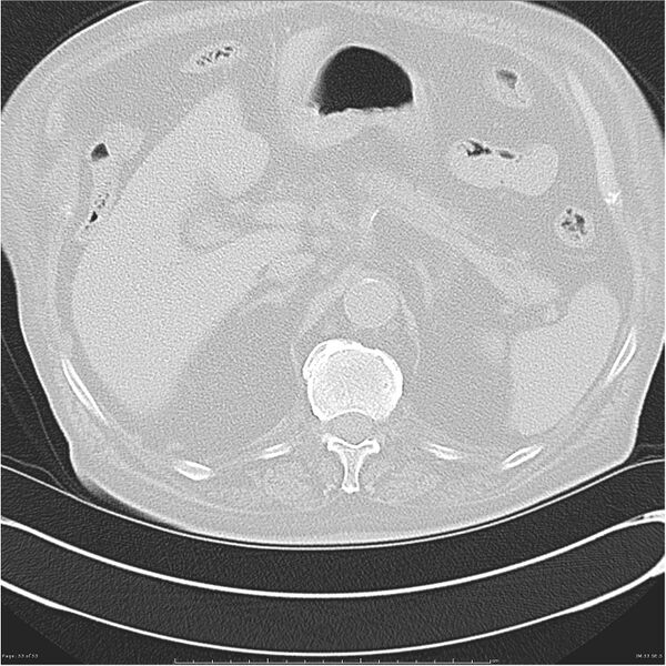 File:Cavitating left lower lobe lesion - squamous cell lung cancer (Radiopaedia 27749-28176 Axial lung window 53).jpg