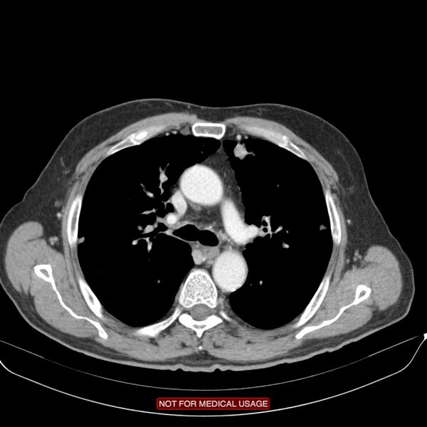 File:Cavitating pulmonary metastases (Radiopaedia 24920-25184 B 9).jpg