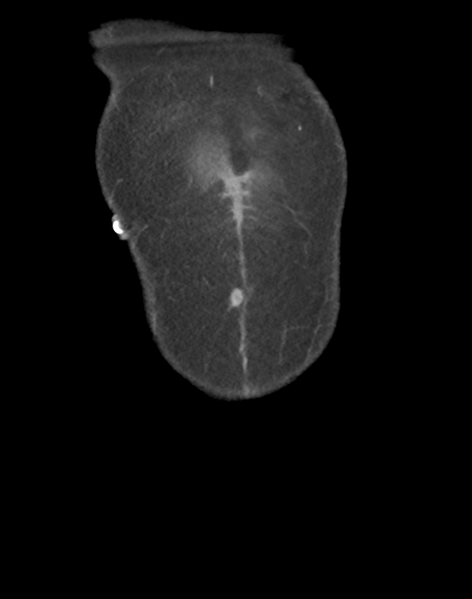 File:Cecum hernia through the foramen of Winslow (Radiopaedia 46634-51112 B 4).png