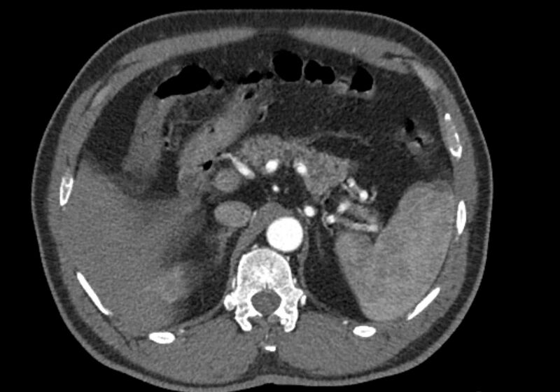 File:Celiac artery dissection (Radiopaedia 52194-58080 A 26).jpg