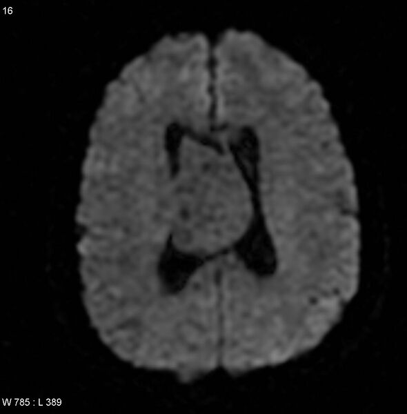 File:Central neurocytoma (Radiopaedia 4956-6850 Axial DWI 1).jpg