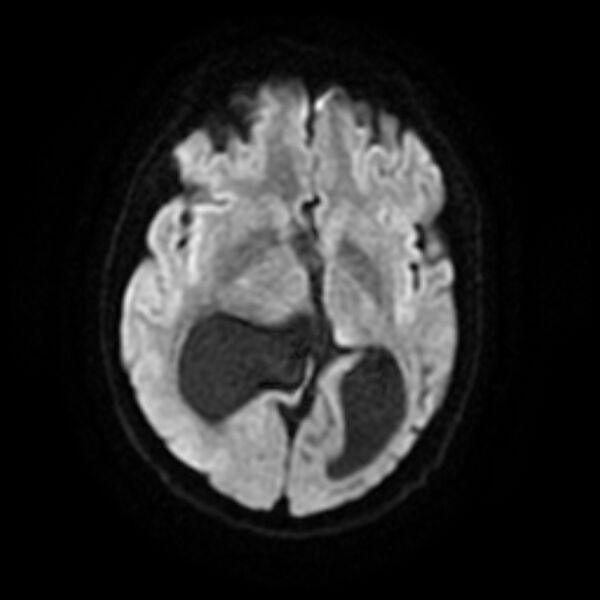 File:Central neurocytoma (Radiopaedia 67618-77021 Axial DWI 10).jpg