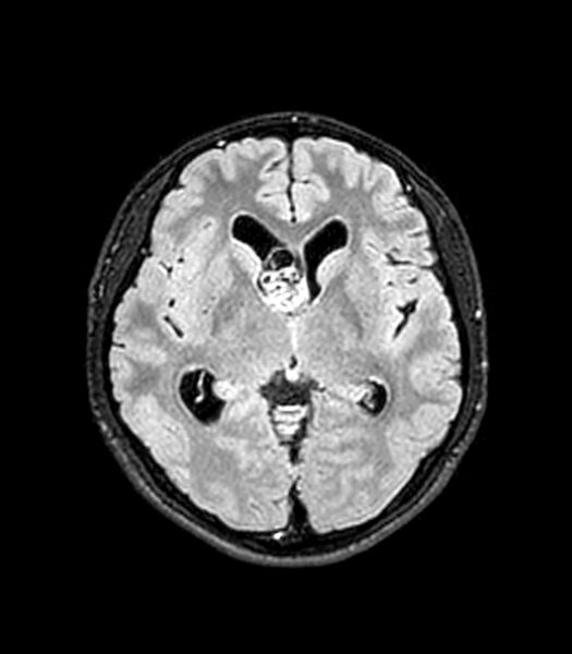 File:Central neurocytoma (Radiopaedia 79320-92380 Axial FLAIR 168).jpg