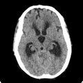 Cerebellar abscess secondary to mastoiditis (Radiopaedia 26284-26412 Axial non-contrast 67).jpg