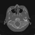 Cerebellar abscess secondary to mastoiditis (Radiopaedia 26284-26413 Axial bone window 24).jpg