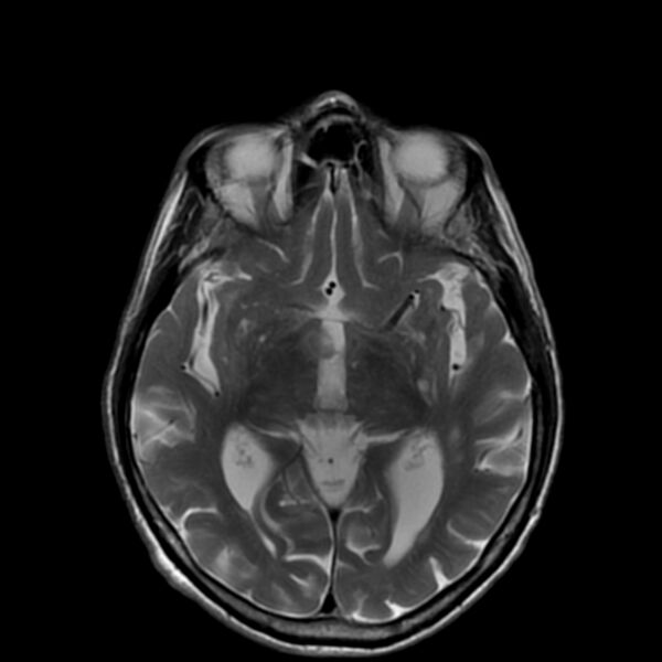 File:Cerebellar ataxia with neuropathy and vestibular areflexia syndrome (CANVAS) (Radiopaedia 74283-85159 Axial T2 11).jpg