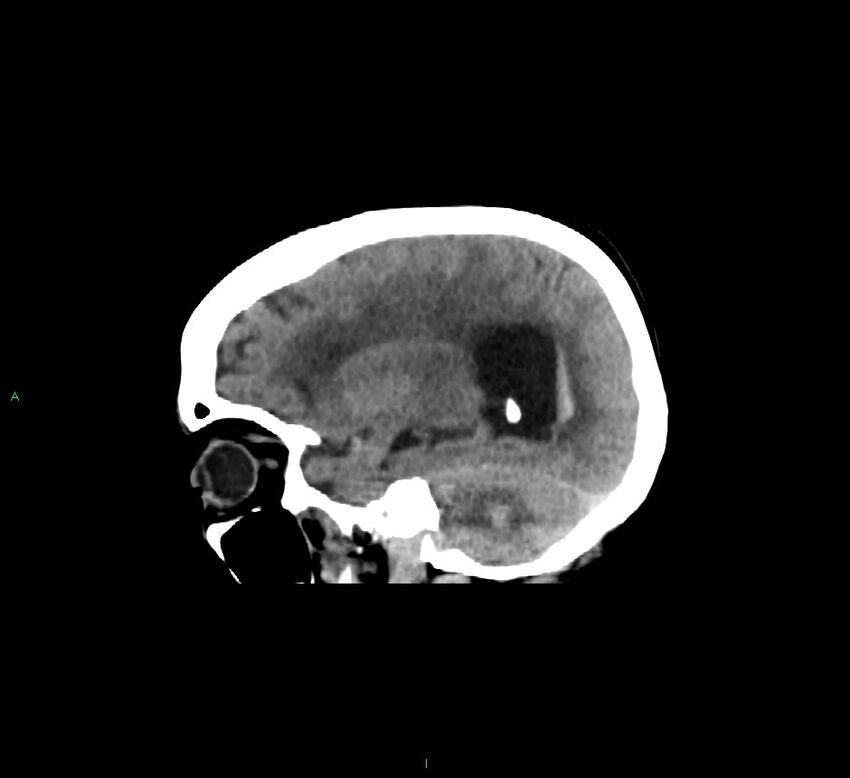 Cerebellar hemorrhage (Radiopaedia 58793-66027 C 18).jpg